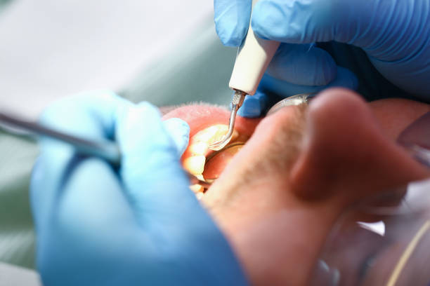 Best Emergency Wisdom Teeth Removal in Fairport, NY